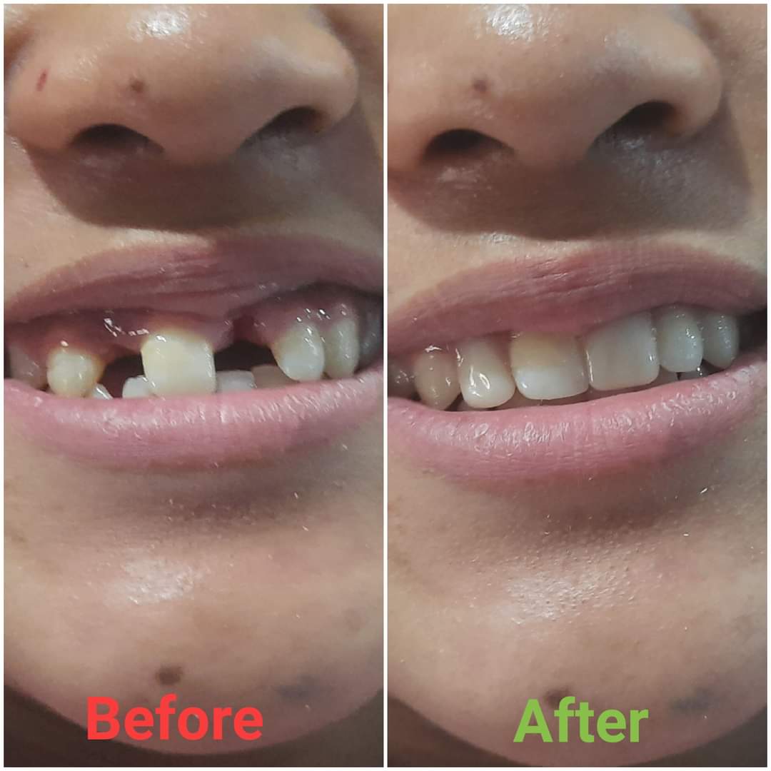 Orthodontic treatment in Gwalior