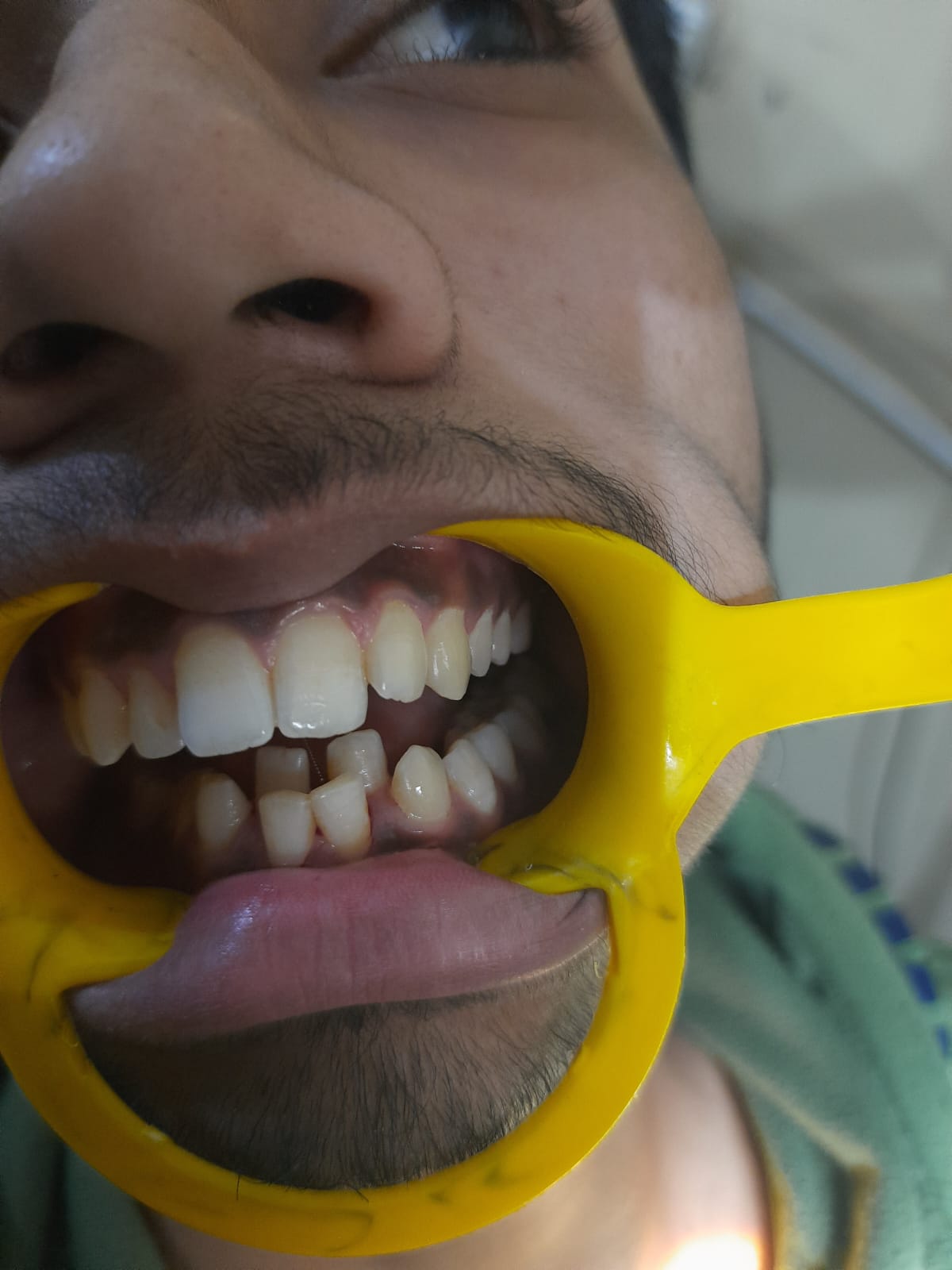 teeth whitening in gwalior madhya pradesh