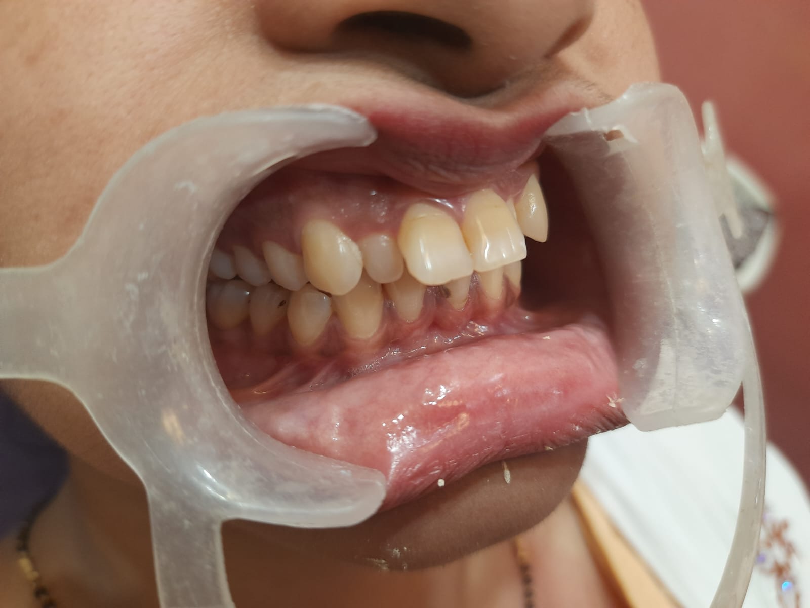 Root Canal Treatment in gwalior 