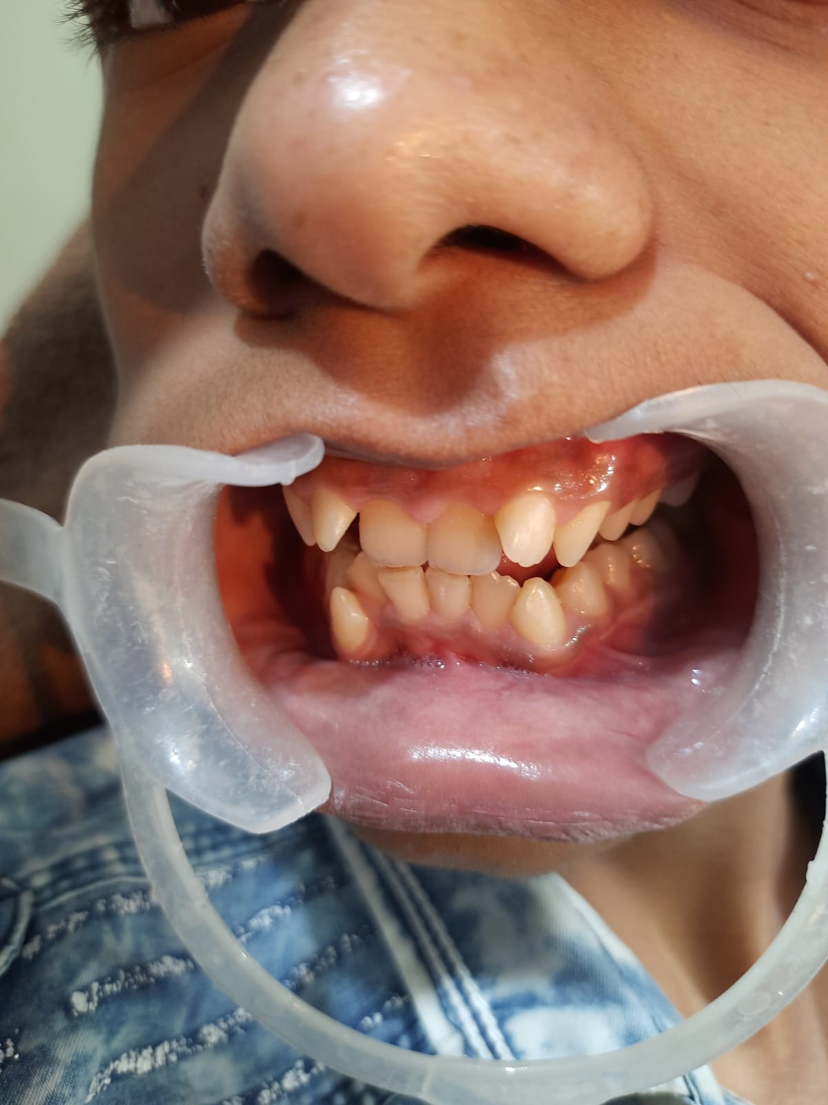 Root Canal specialist in gwalior
