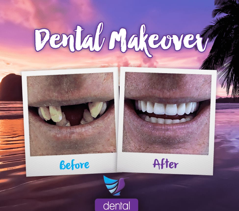 Dental Implants in gwalior
