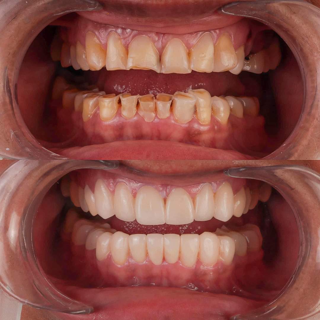 Dental Implants in gwalior
