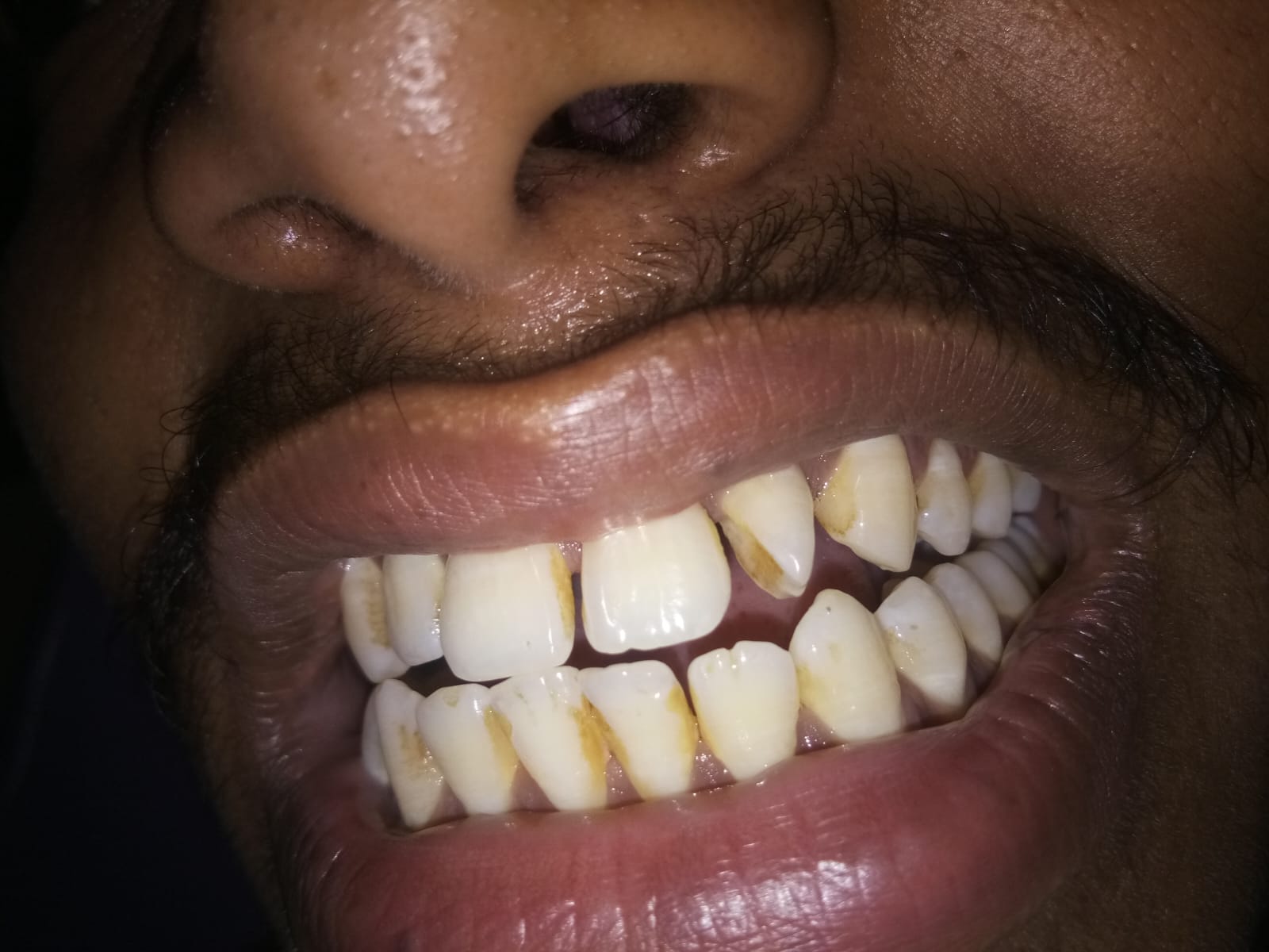 Dental Implants in gwalior