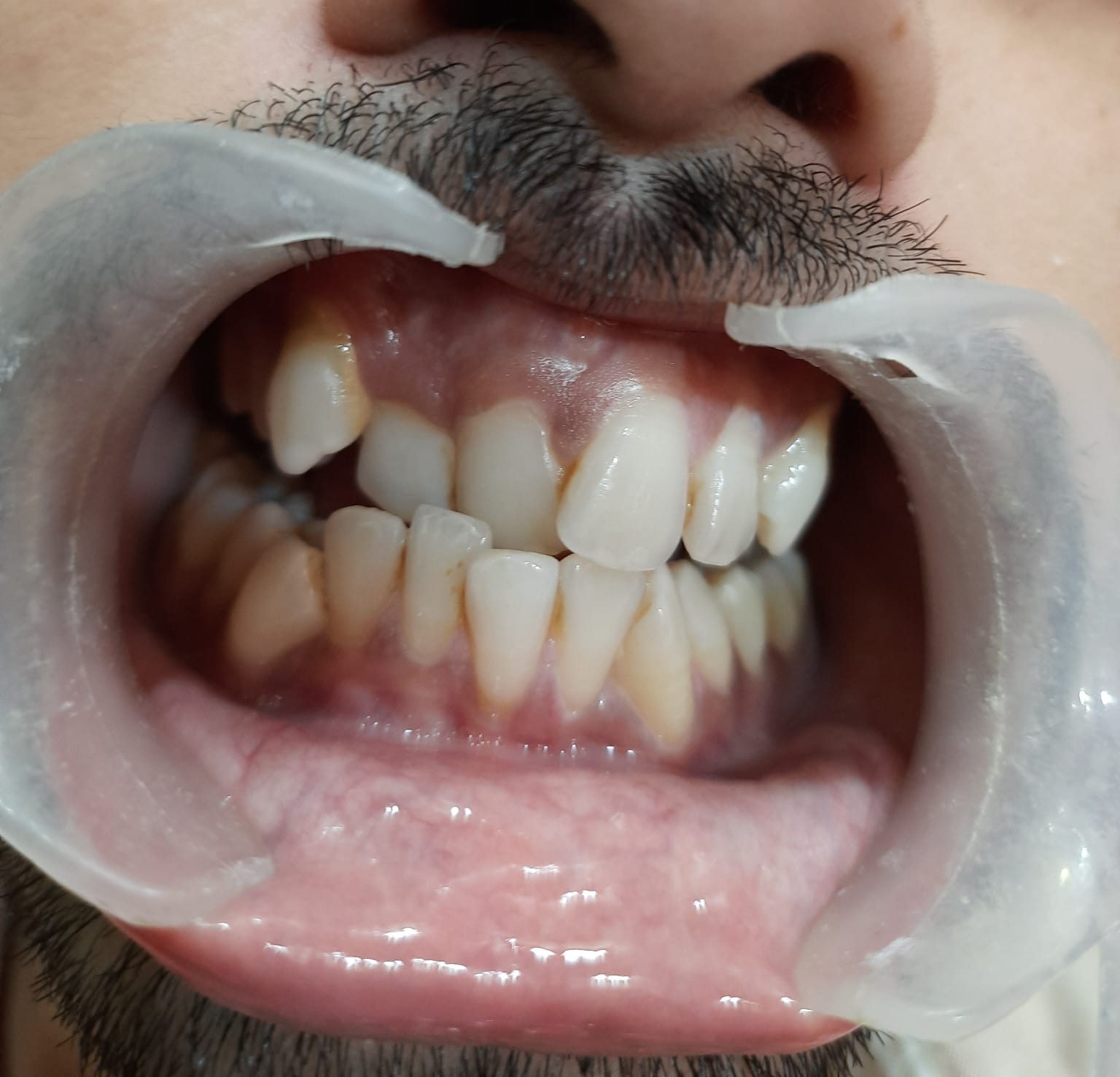 Teeth doctar in gwalior